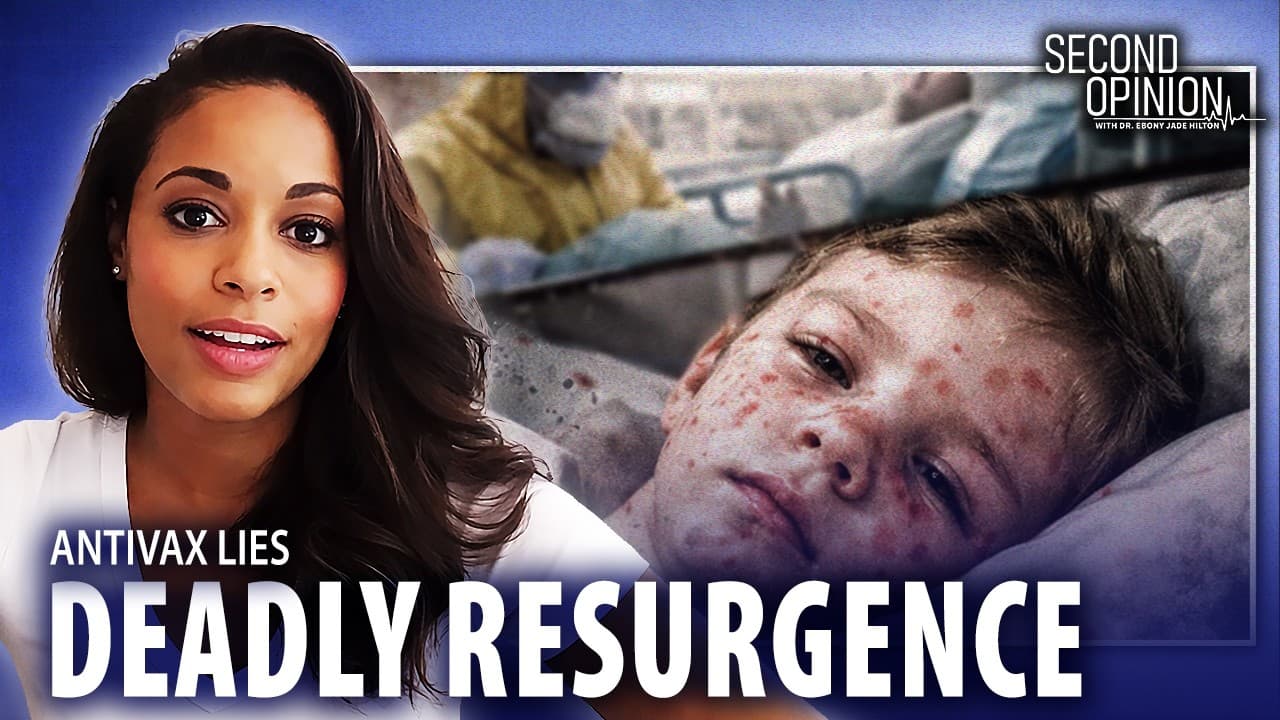RFK’s Antivax Push. Measles Resurges Across America